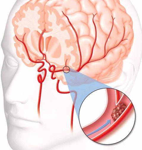 blood clot brain sugery