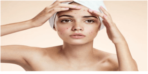 Get Rid of Acne Overnight