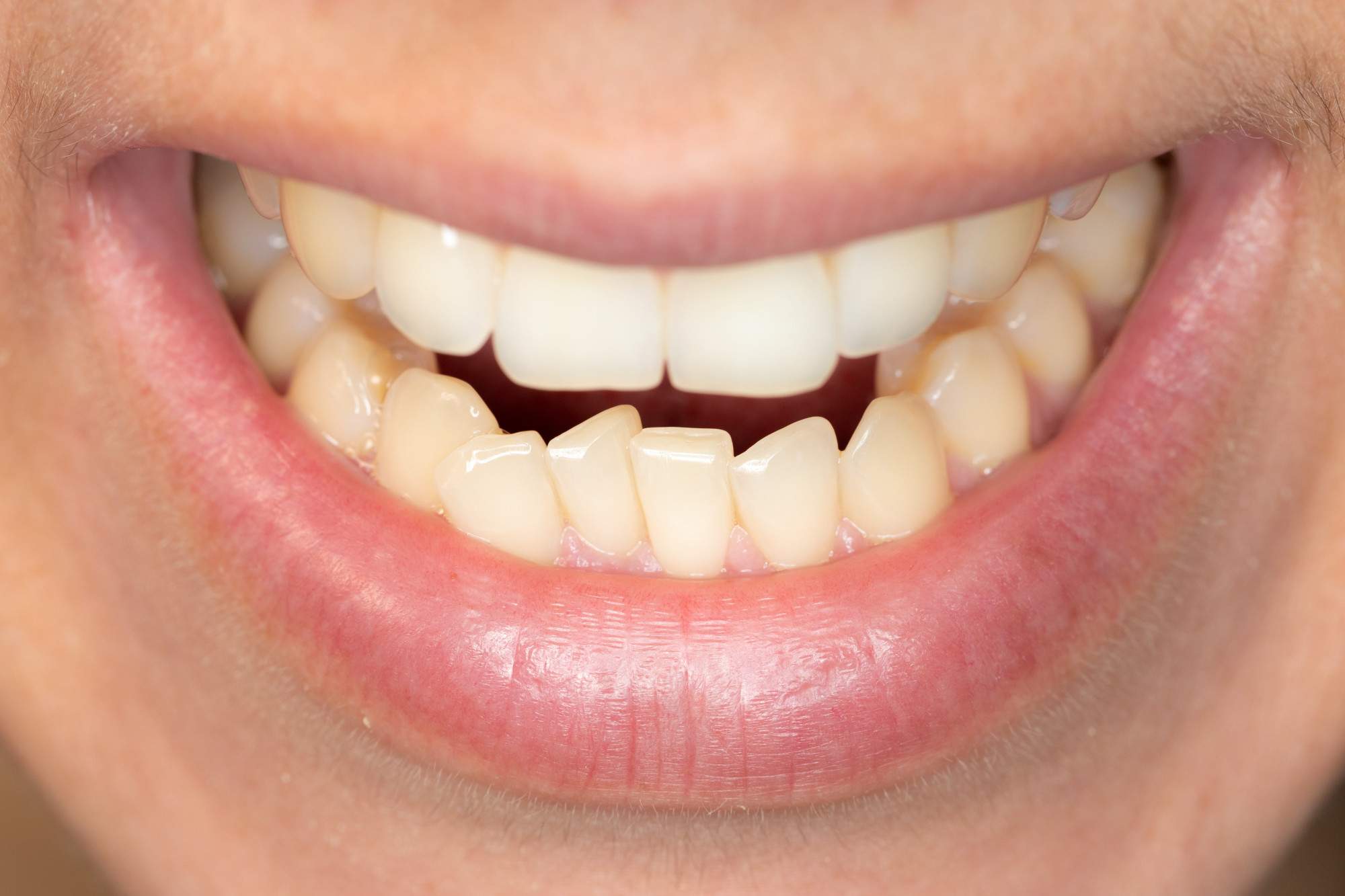 5 Major Signs You Need Braces