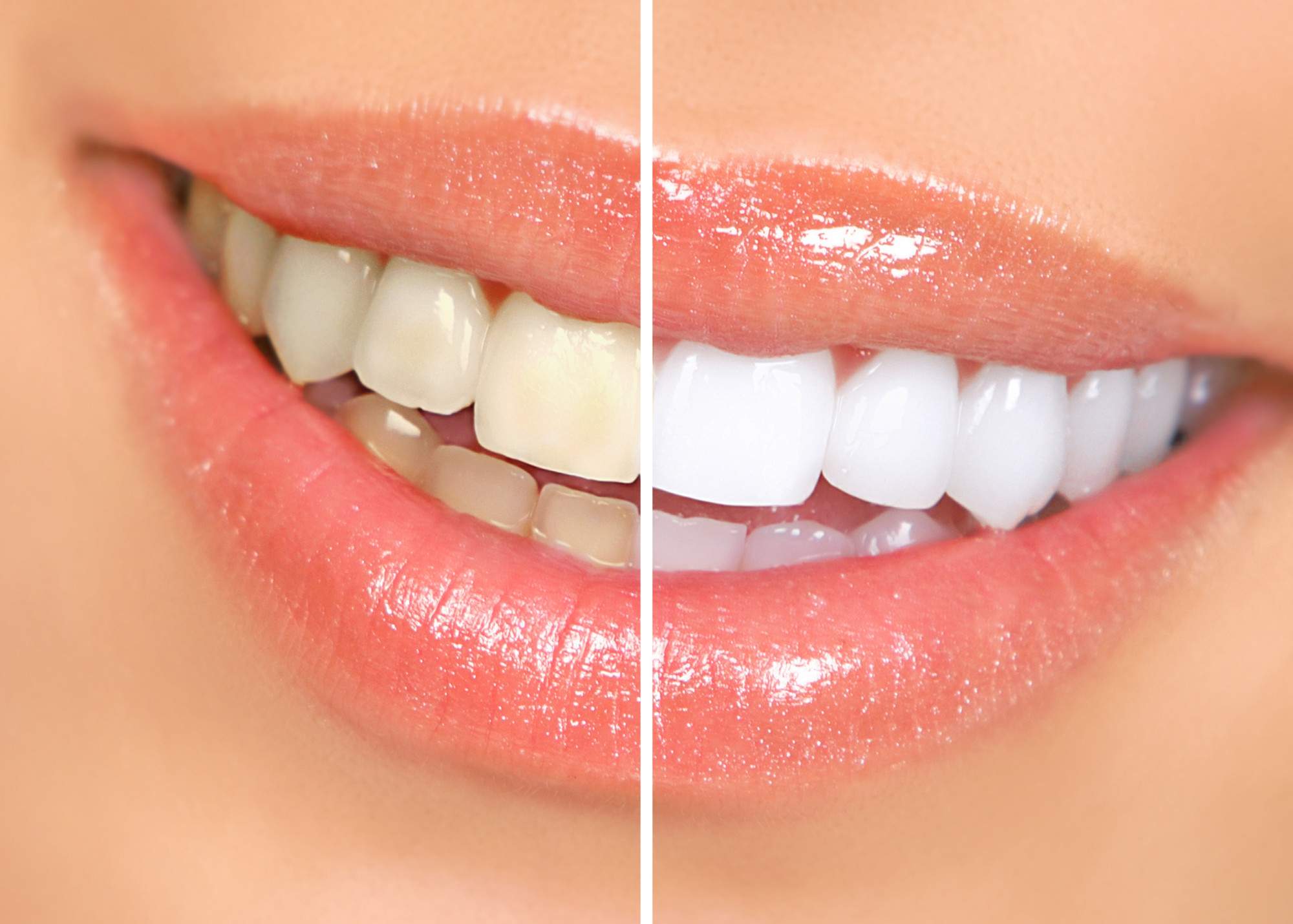 What Causes Brown Spots and Stains on Teeth?