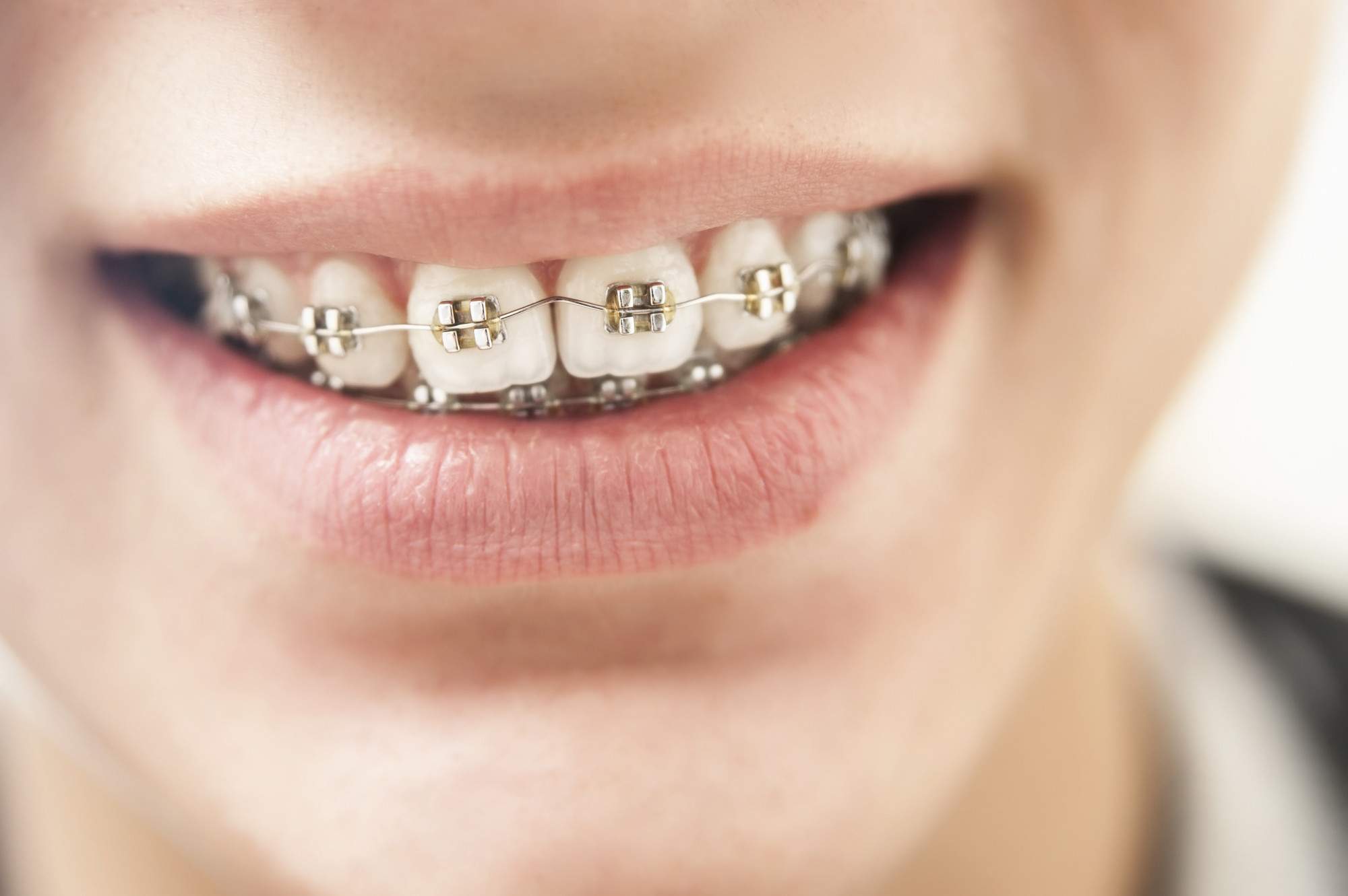 Best Age for Braces to Correct Misaligned Teeth