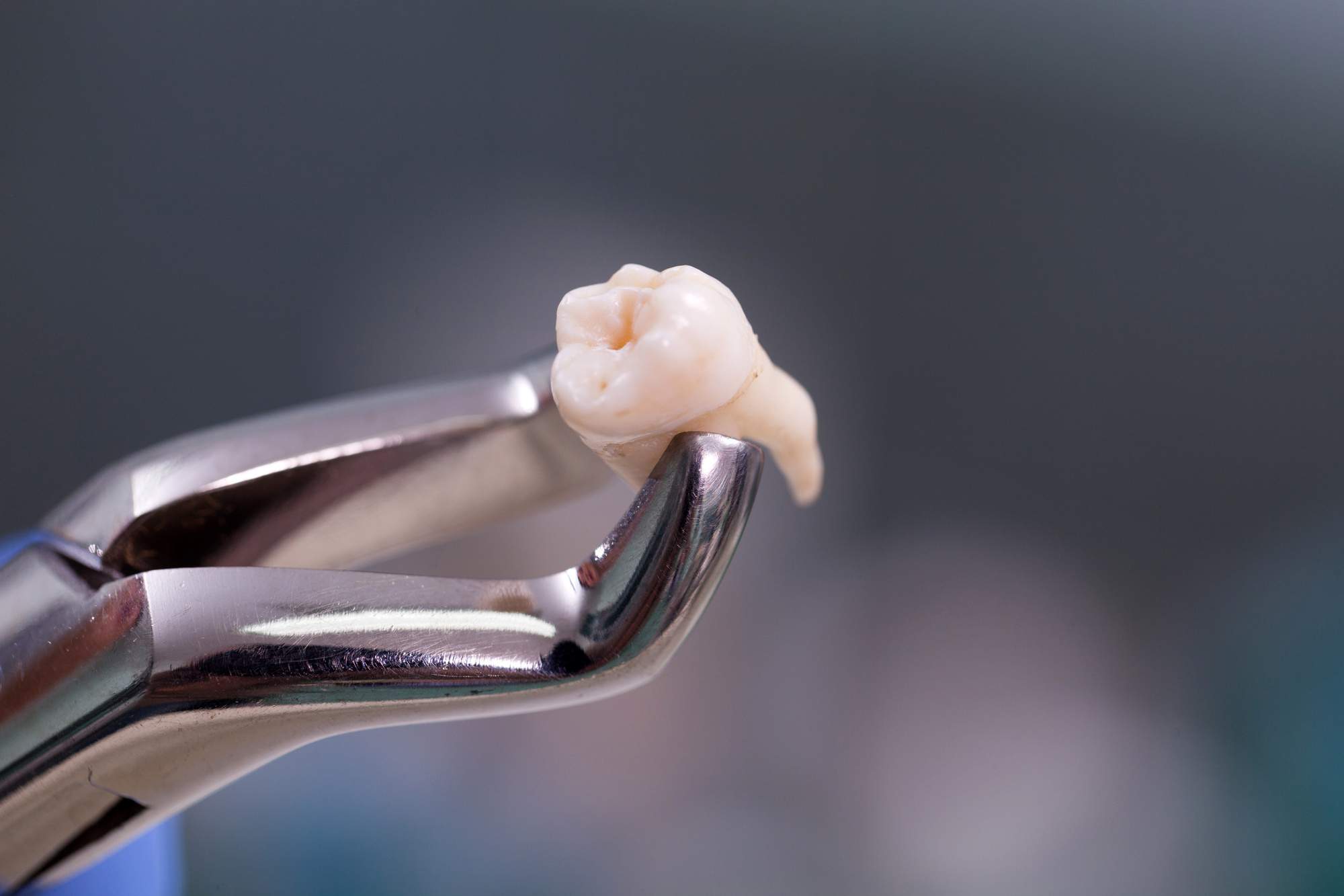 5 Options for Replacing Missing Teeth
