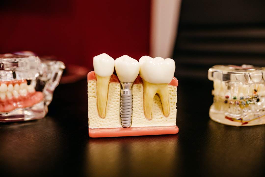 Missing Teeth? 5 Practical Benefits of Dental Implants