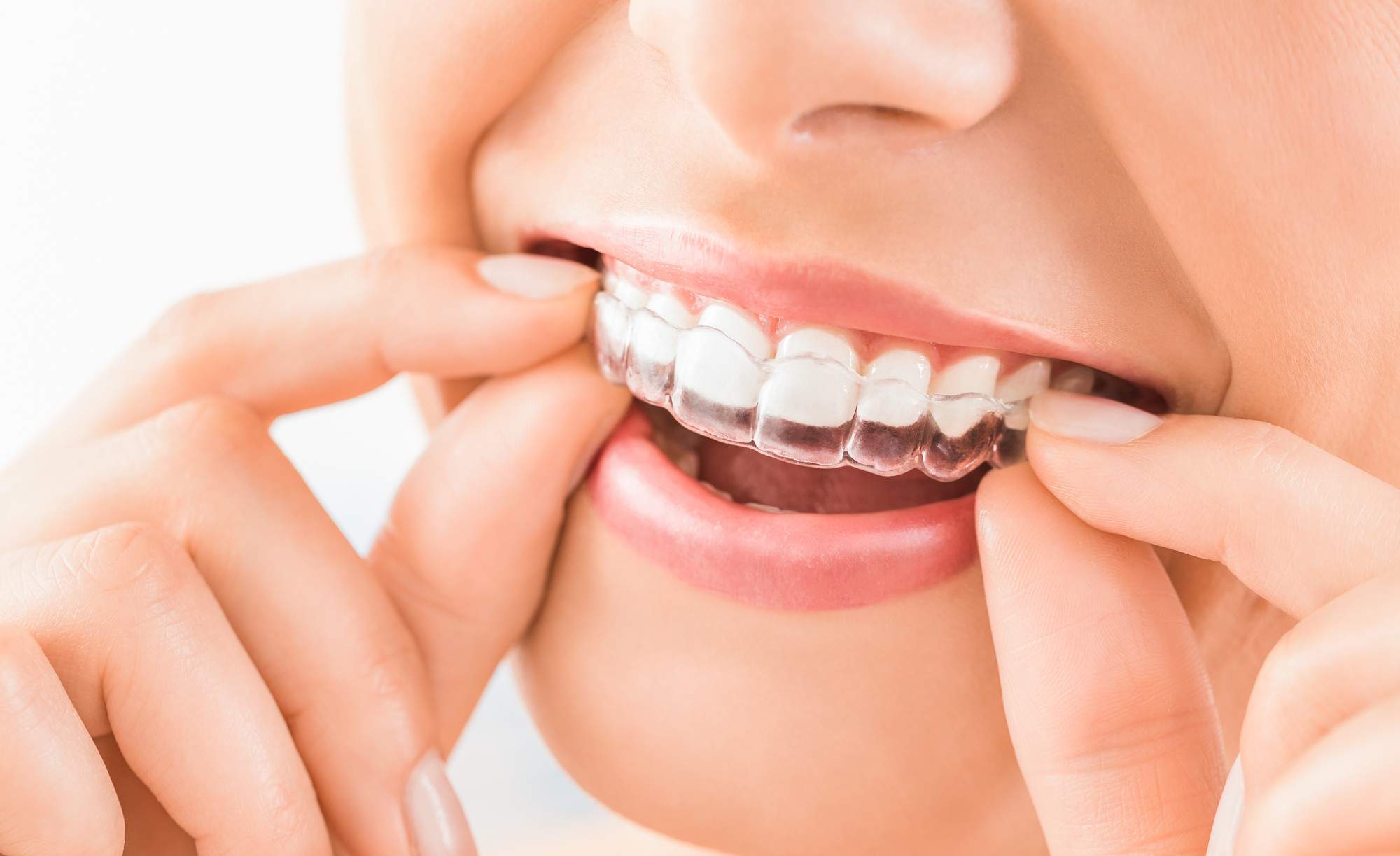 Top 5 Factors to Consider When Choosing Invisalign Providers