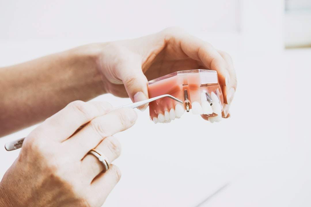 How Much Do Dental Implants Cost? A Complete Guide