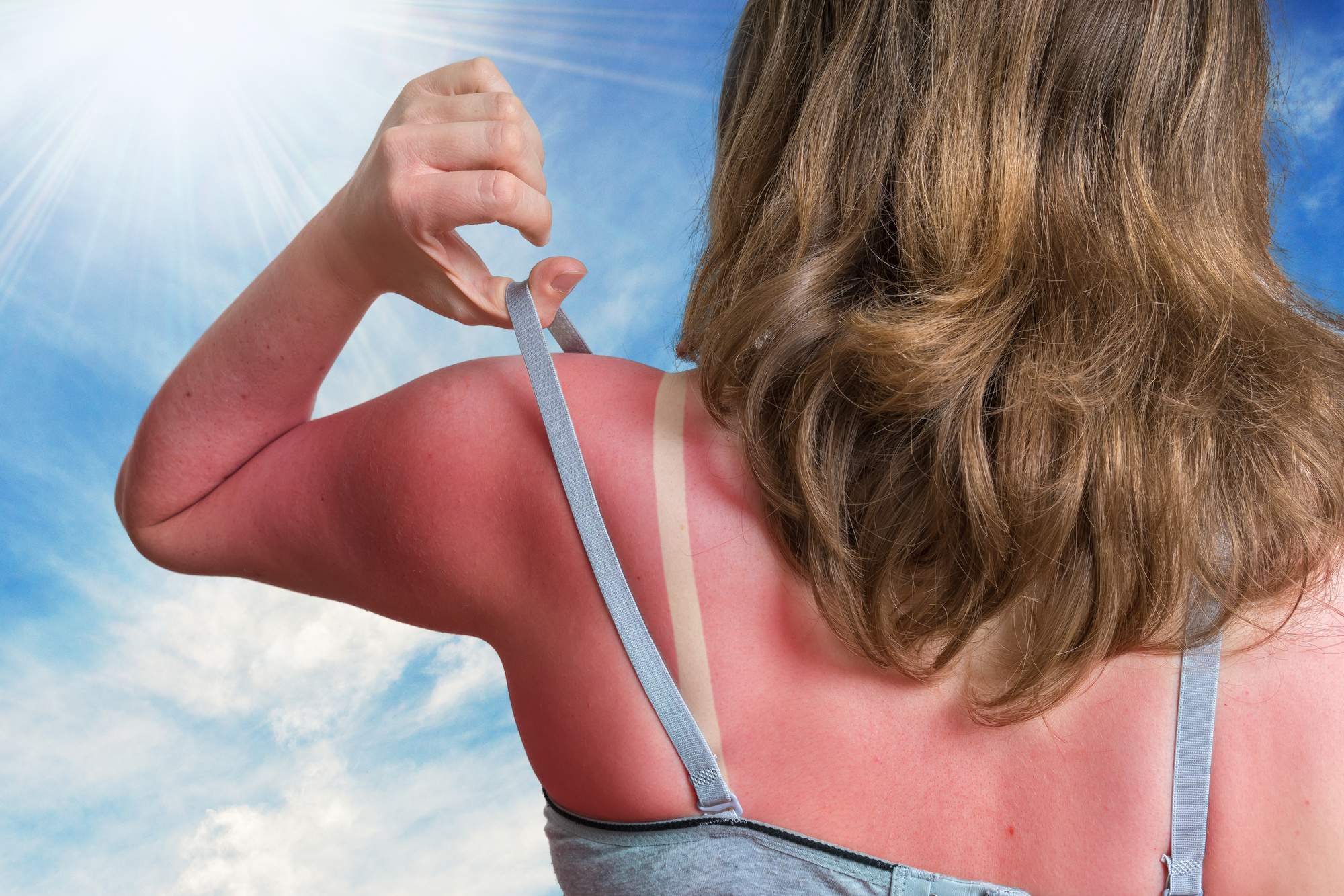 The Downsides of Excessive Sun Exposure