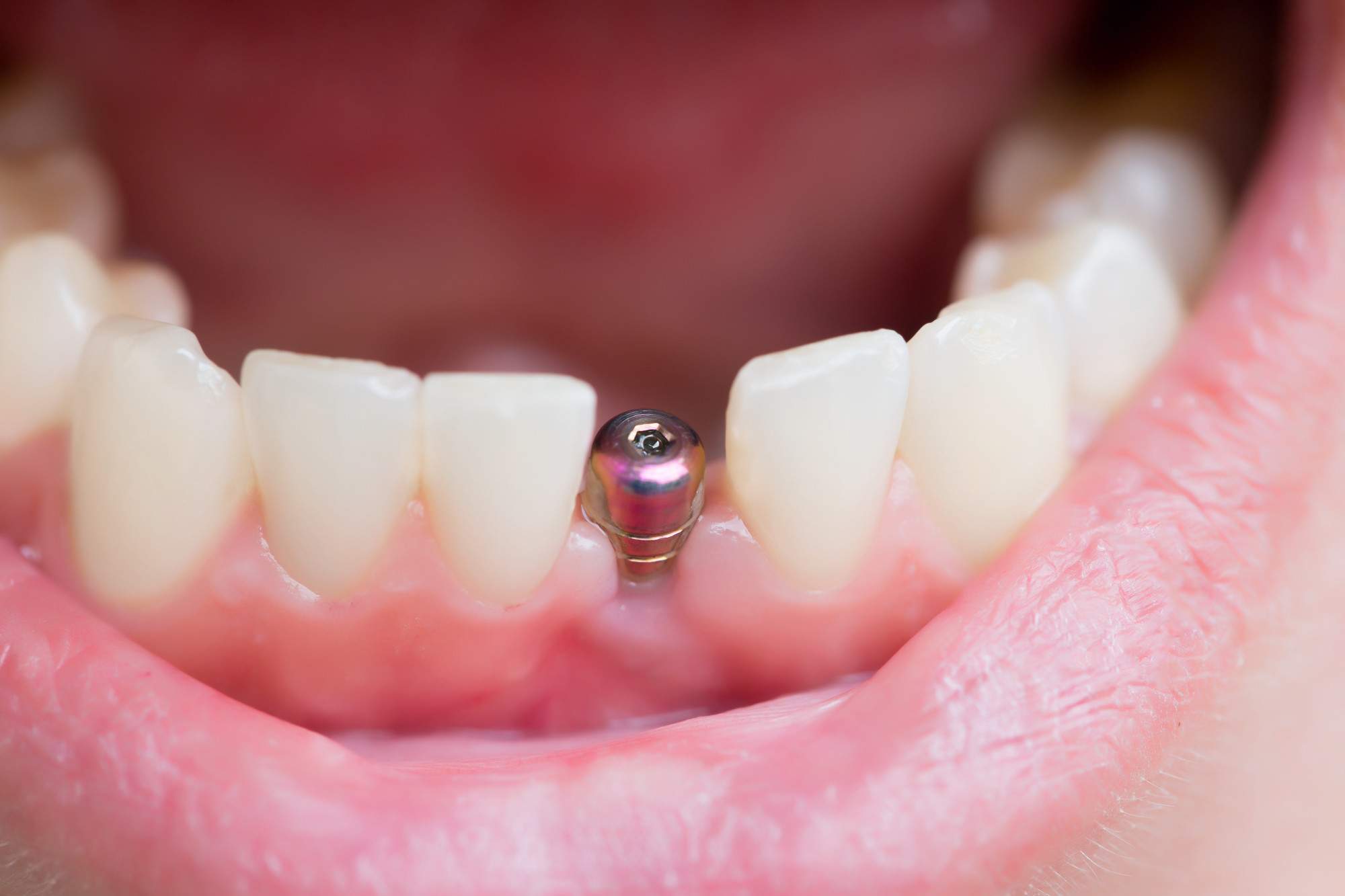 4 Signs You’re a Candidate for Dental Implants