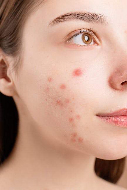 Eczema vs Acne: What Are the Differences?