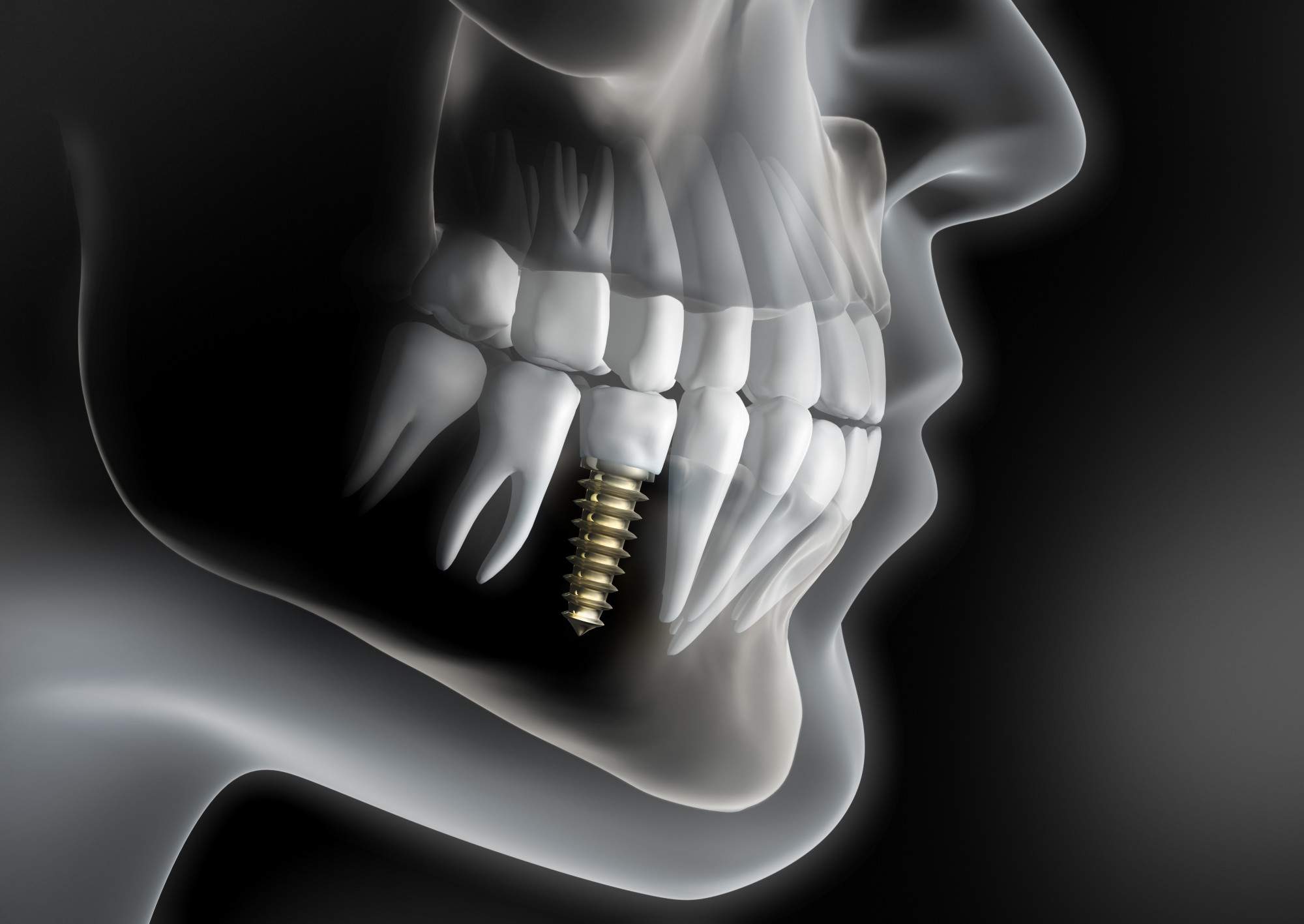 What Are Your Options for Teeth Replacement?