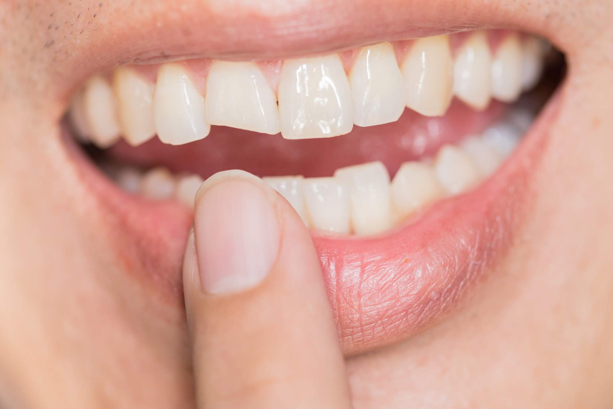 What Is the Best Way to Fix Broken Teeth?