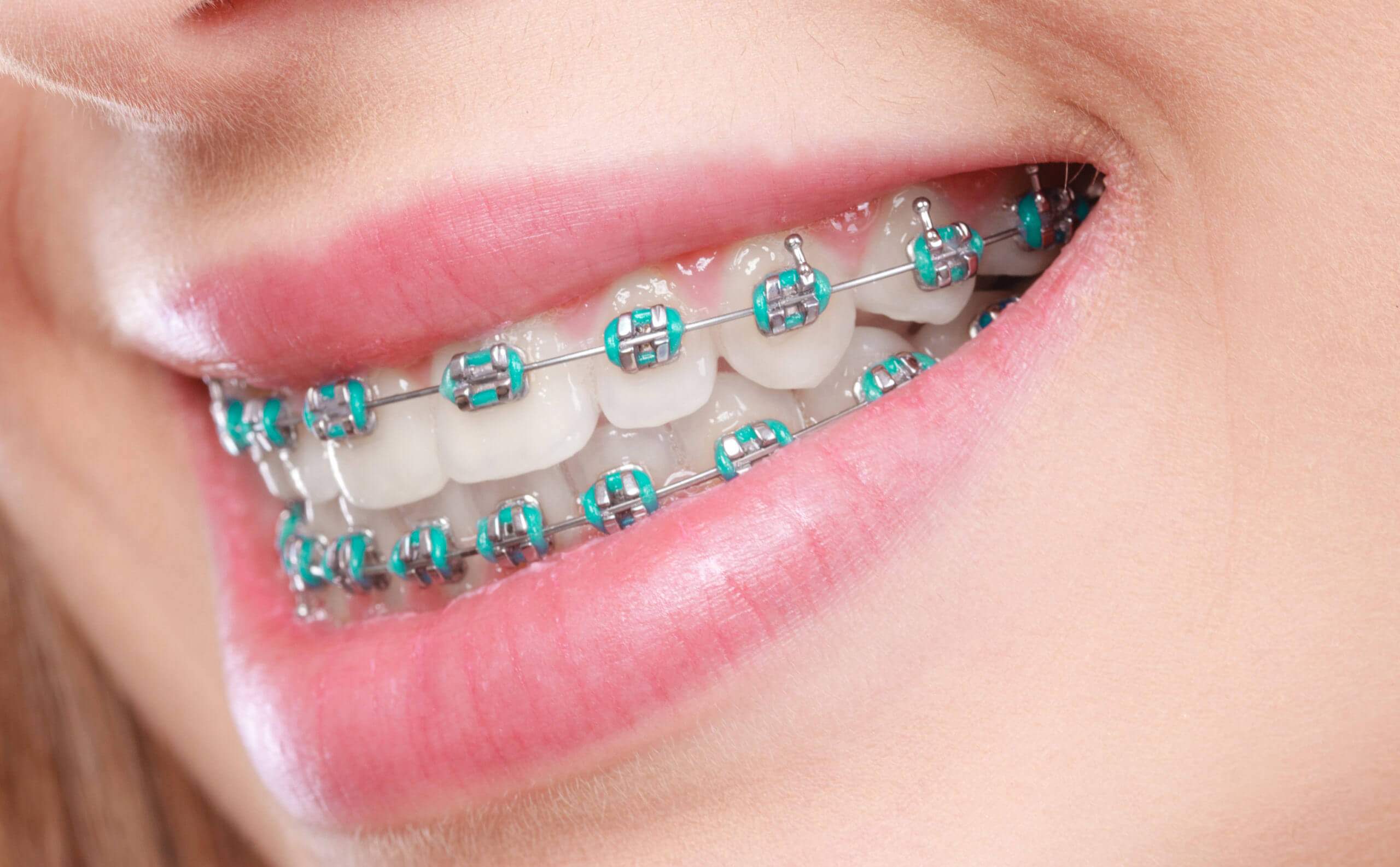 Gain A Picture-Perfect Smile With Traditional Braces