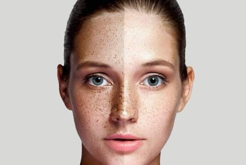 understanding skin pigmentation & its treatments