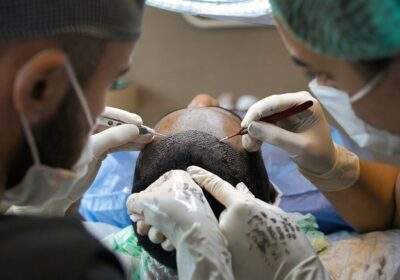What to Expect After FUE Hair Transplant Surgery